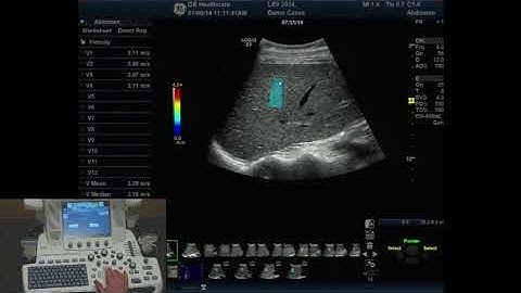 Elastography SWE