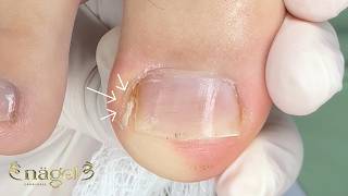 Dor, pele inflamada e unha: Como conduzi este caso de um paciente de Portugal #satisfying #nails