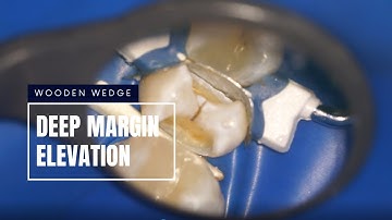 DEEP MARGIN ACQUISITION and ELEVATION (DMA&DME) with wedge
