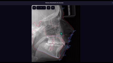 CephNinja custom analysis creation demo for orthodontists. AI-Powered Cephalometric Analysis