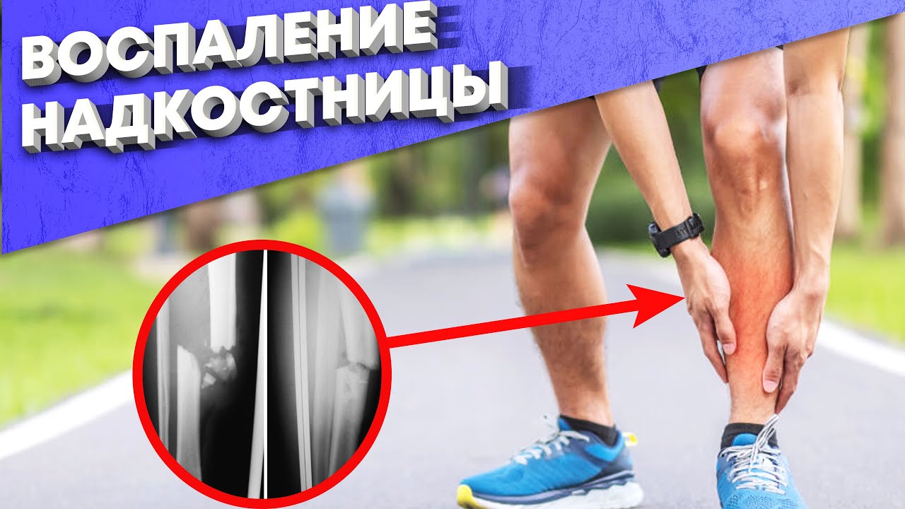 Воспаление Надкостницы. Что это? Как этого избежать? Как это лечить ...