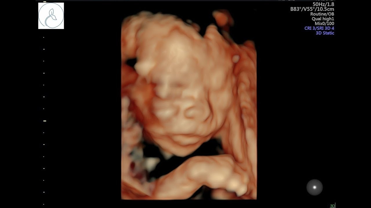 3D Ultrasound At 22 Weeks! - YouTube