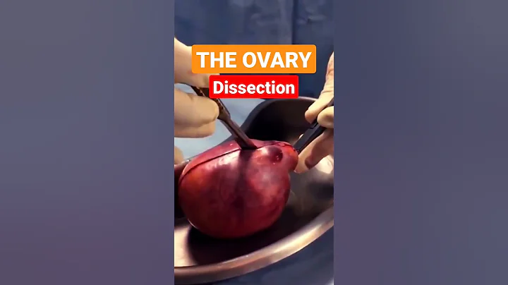 Dissection of Ovarian Teratoma - DayDayNews