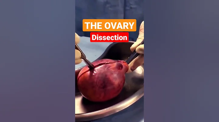 Dissection of Ovarian Teratoma - DayDayNews