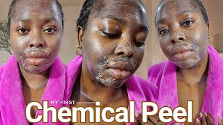 Chemical Peel Full Process | Procedure, Before & After, Skin Shedding, Tips + Final Review
