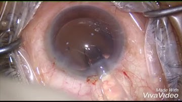 Rajan Eye Care Live - Lucidis EDOF IOL