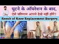 घुटने के ऑपरेशन के बाद परिणाम | Best Result After Knee Replacement Surgery | Dr Dahiya Physiotherapy