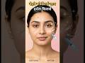 डर्मल फिलर्स से चेहरा बने जवां | बिना सर्जरी का ब्यूटी सीक्रेट! #dermalfillers #skincare #shorts
