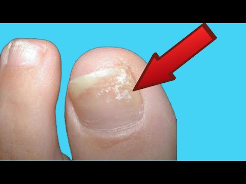 Video: 3 formas de deshacerse de la psoriasis en las uñas