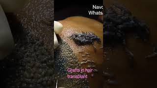 9416500112,  HD Live Hair transplant Implantation | Hair Graft looks