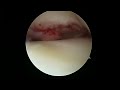 Minimally Invasive Knee Surgery - Arthroscopic All Inside Lateral Meniscus Repair (Bucket Handle).