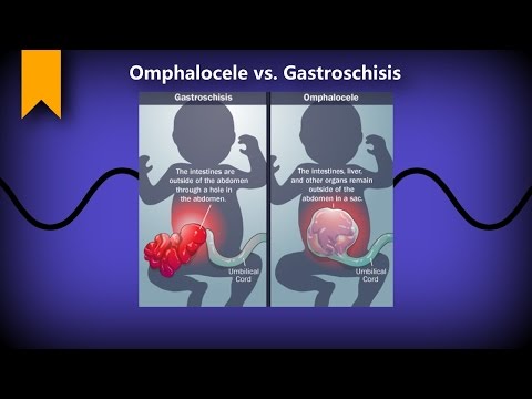 Video: Gastroschisis: Foto, årsaker, Konsekvenser