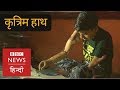 Delhi Boy gets Prosthetic Hand Under Right to Education (BBC Hindi)