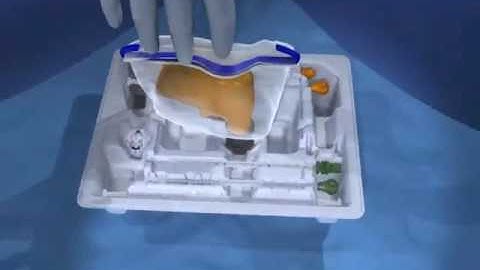 Arrow® OnControl® Bone Lesion Biopsy Procedure
