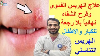 علاج الهربس الفموى وقرح الشفاه نهائيآ بلا رجعة | الوقاية العلاج الفعال للكبار والاطفال | هربس تناسلي