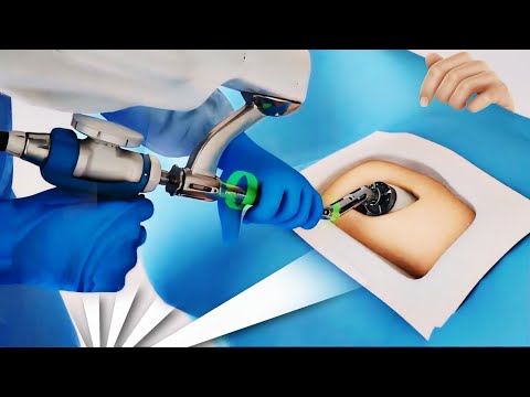   Total Hip Replacement Surgery 3D Animation