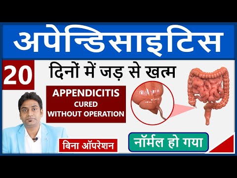 Appendicitis Treatment Without Surgery | |