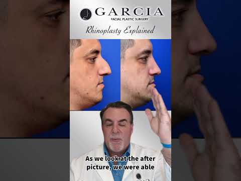 Male Rhinoplasty Explained