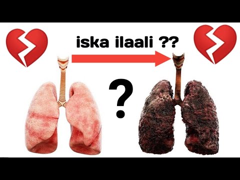 🔴CUDURKA BURUKIITADA ( BRONCHITIS ) IYO SIDA LOO DAAWEEYO ?? DR TIMAJILAC 2020........