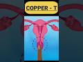 Ref:qvFpzjpZPQU Coppert (intrauterine device) #shorts #youtubeshorts