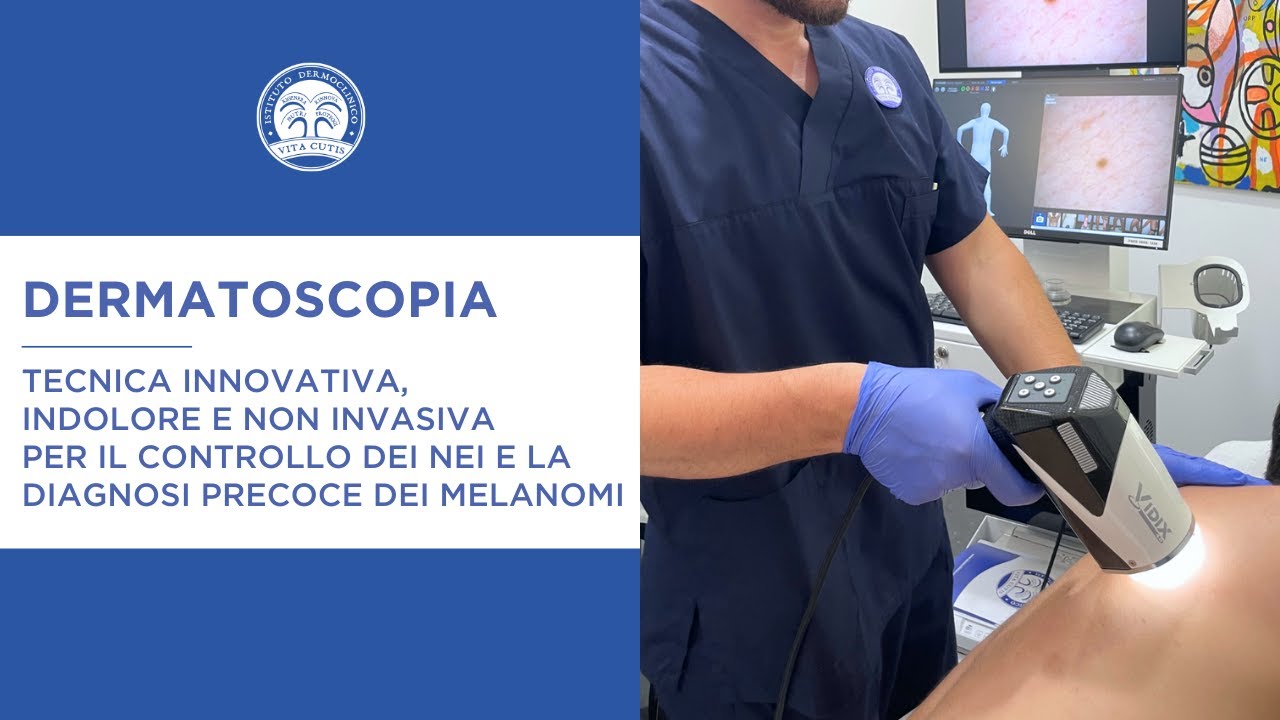 Dermatoscopia - tecnica per il controllo dei nei e la diagnosi precoce ...