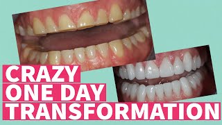 Full Mouth Rehabilitation, Reconstruction, Restoration of SEVERE TOOTH WEAR! - Smile Makeover