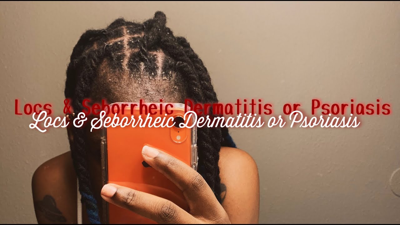How I’ve found relief with having locs & Seborrheic Dermatitis or ...