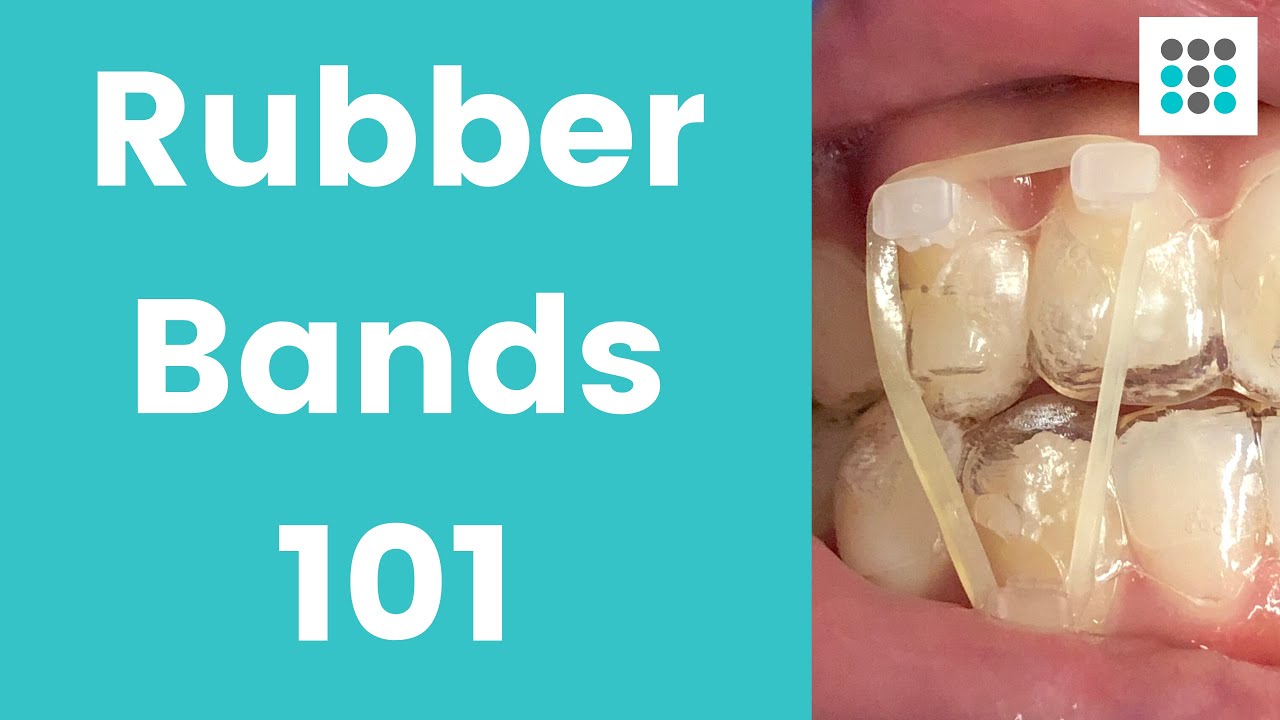 Rubber Band Wear - Orthodontist Vancouver WA