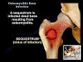 Osteomyelitis Bone Infection - Everything You Need To Know - Dr. Nabil Ebraheim