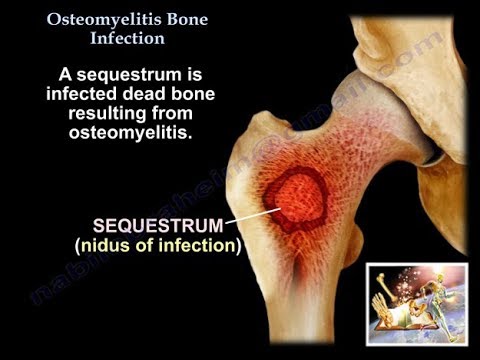 Osteomyelitis