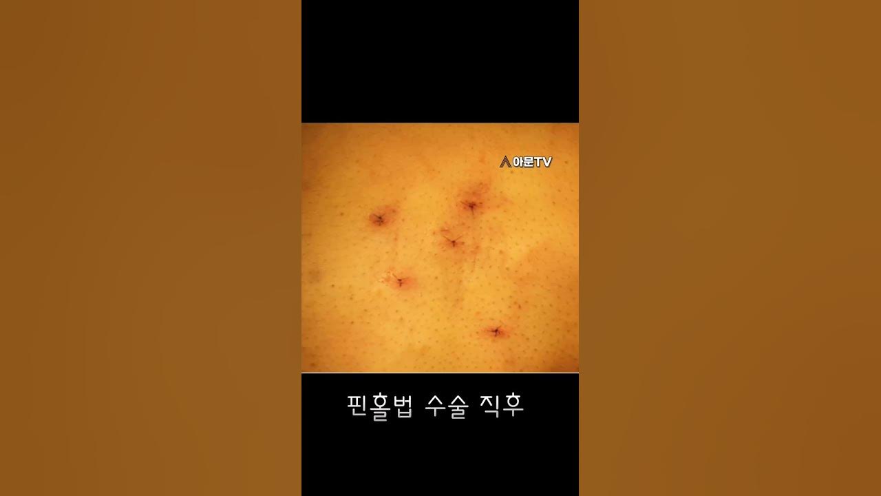 피지낭종 핀홀법 생생한 후기 (성형외과 수술)[아문Tv] - Youtube