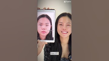 Phục hình lại chiếc mũi co rút hếch ngược lên #bsnguyentienhuy