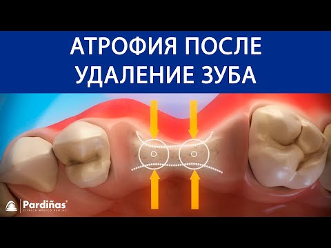 Видео: Фрактура на зъба при кучета