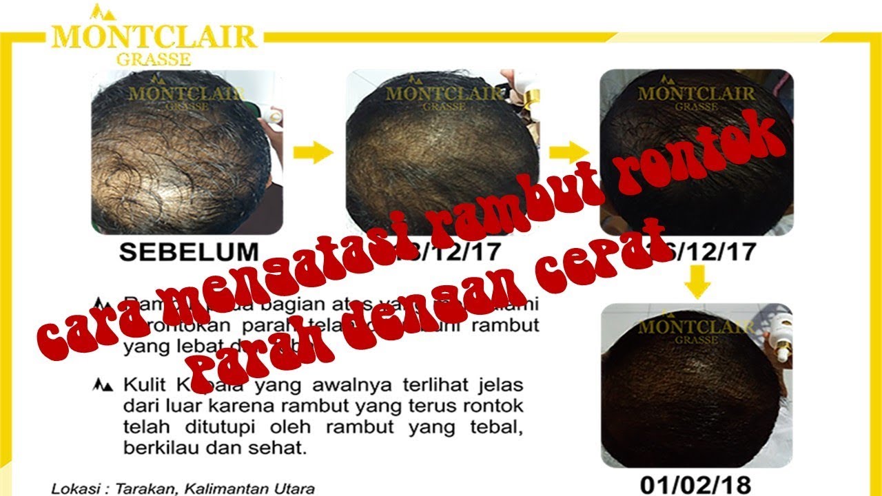 Cara Mengatasi Rambut Rontok Parah Dengan Cepat YouTube