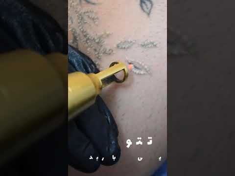 ریموو تاتو با دستگاه کیوسوئیچ بدون زخم خون ریزی