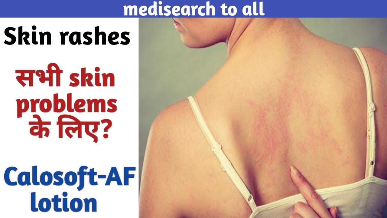 CalosoftAF lotion,Uses,सभी skin problems के skin rashes