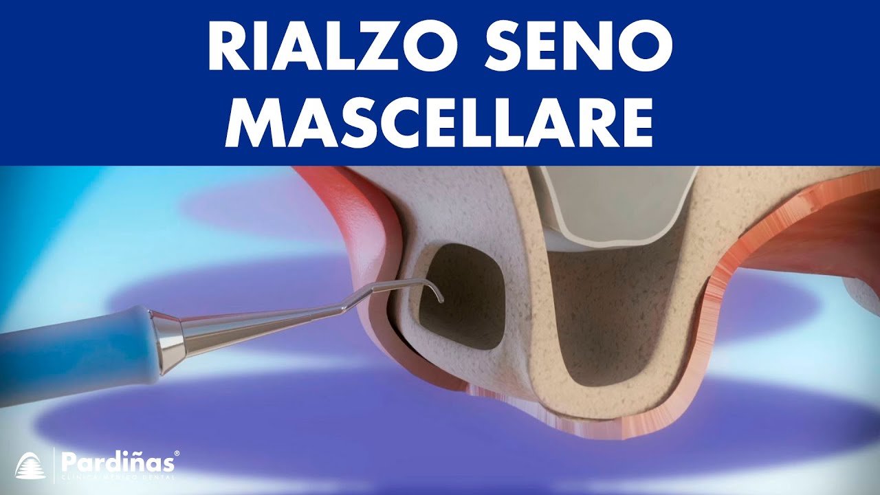 Rialzo seno mascellare ©