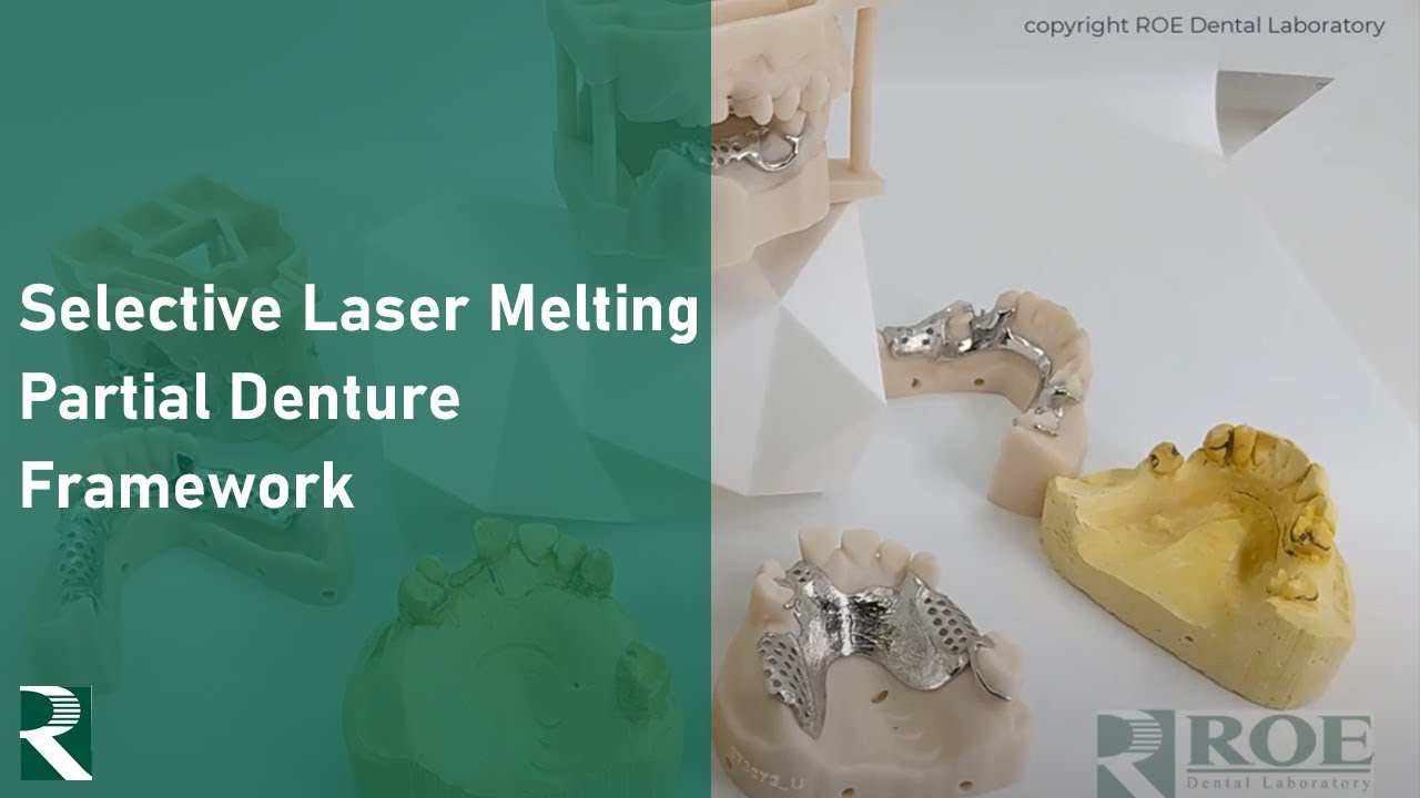 Utilizing Selective Laser Melting (SLM) for Partial Denture Frameworks YouTube