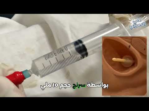 طريقة رفع الفولي او ازالة القسطرة البولية Remove Indwelling Catheter