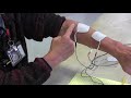 Stroke Rehabilitation: Use of electrical stimulation to help arm and hand recovery