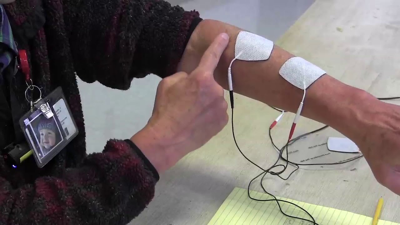 Stroke Rehabilitation: Use of electrical stimulation to help arm