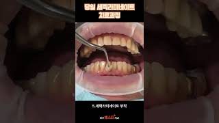 대구 당일 라미네이트 치료과정!! (대구예스타치과)