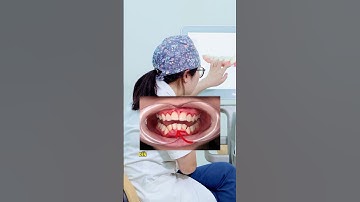 Nguy cơ tiêu xương khi niềng răng | Lạc Việt Intech Niềng Răng #shorts