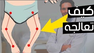 للامهات تقوس الساقين عند الأطفال .. الاسباب وطرق العلاج