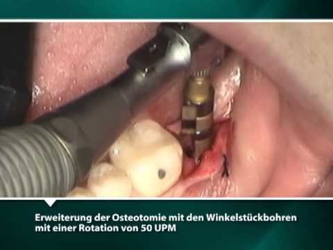 Video: Außerirdische Implantate - Alternative Ansicht