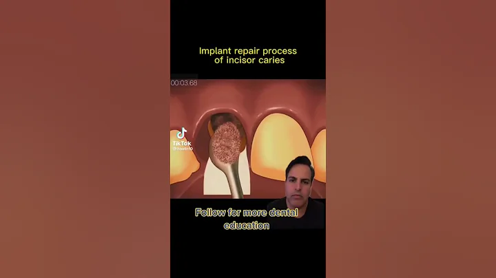 Dentistry explained, how to add a missing front tooth#Dental#Dentistry #Tooth #Shorts #Teeth