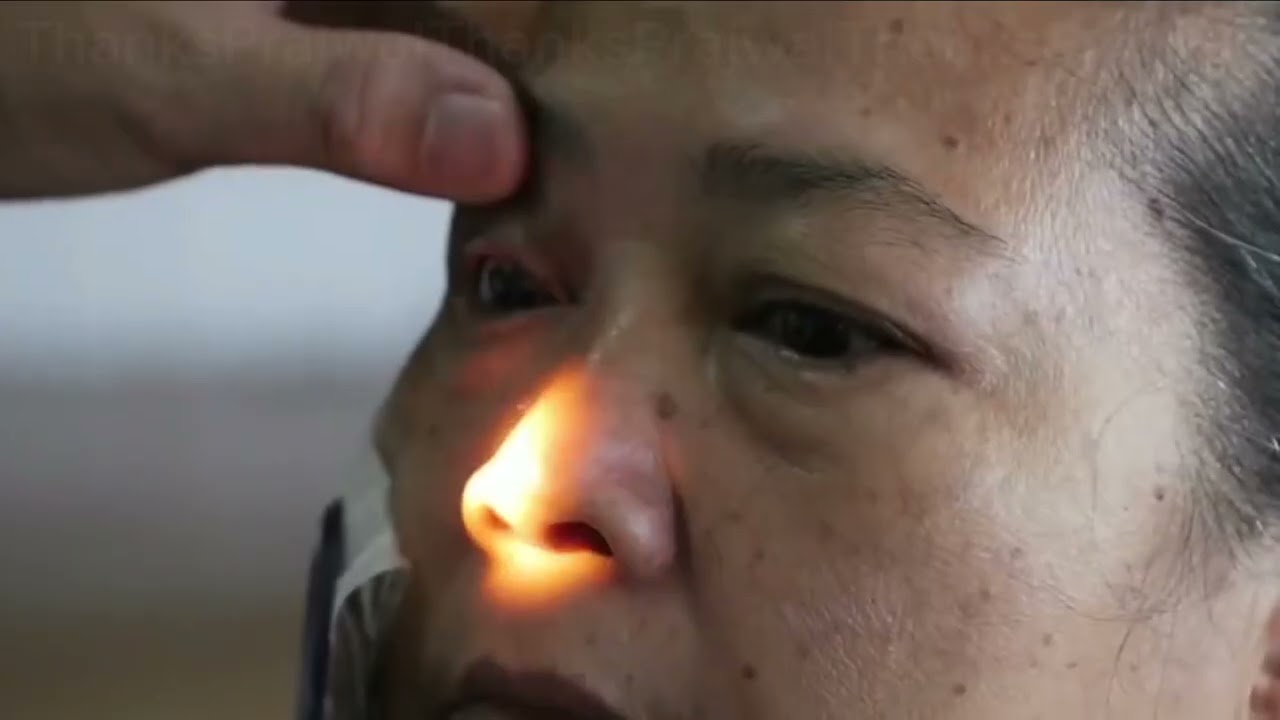 In Myanmar Burma, Free Eye Camp | Cataract Surgery