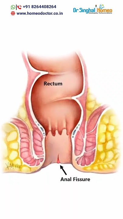 Healing Anal Fissure with Homeopathy | Dr. Vikas Singhal #analfissuretreatment #drvikassinghal