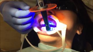 Indirect Bonding at First Impression Orthodontics (full length)