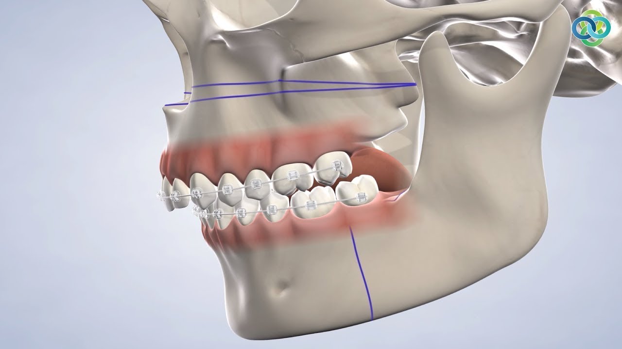 Orthognathic Surgery at Oral Surgery Hawaii in Honolulu, HI YouTube